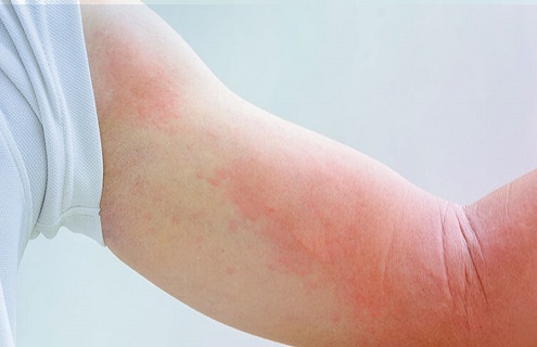 نشانه های خطرناک بیماری پوستی پس از ابتلا به اومیکرون