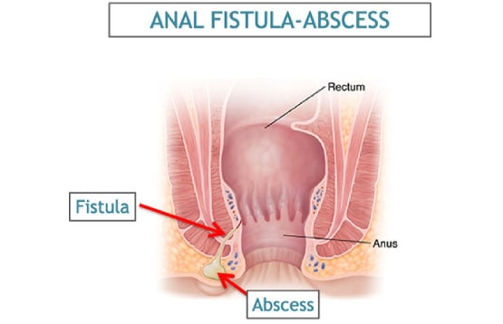 عوارض عمل جراحی فیستول مقعدی چیست؟