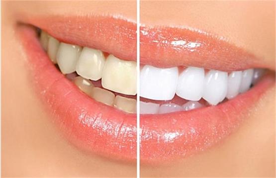 چه فاکتورهایی قیمت لمینت دندان را تعیین میکنند؟